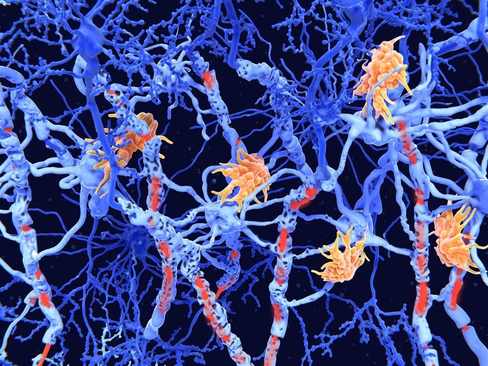 Study: Cell type mapping reveals tissue niches and interactions in subcortical multiple sclerosis lesions. Image Credit: Juan Gaertner/Shutterstock.com