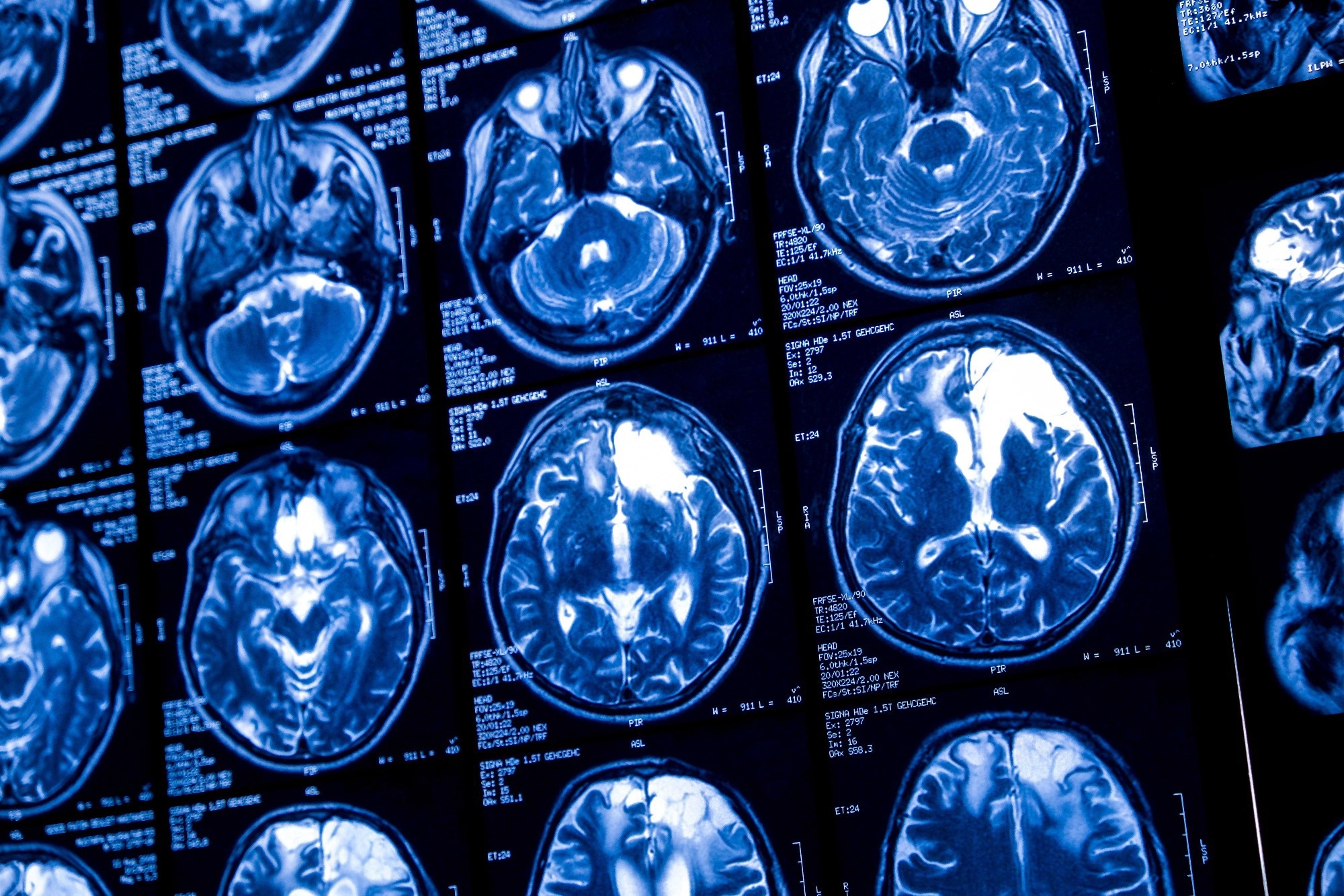 Study: Deep learning and transfer learning for brain tumor detection and classification. Image Credit: Elif Bayraktar/Shutterstock.com