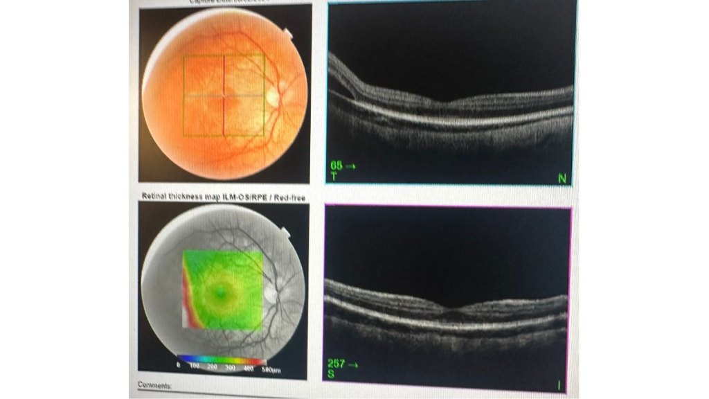 Top: how a detached retina looks; Bottom: how a normal retina looks