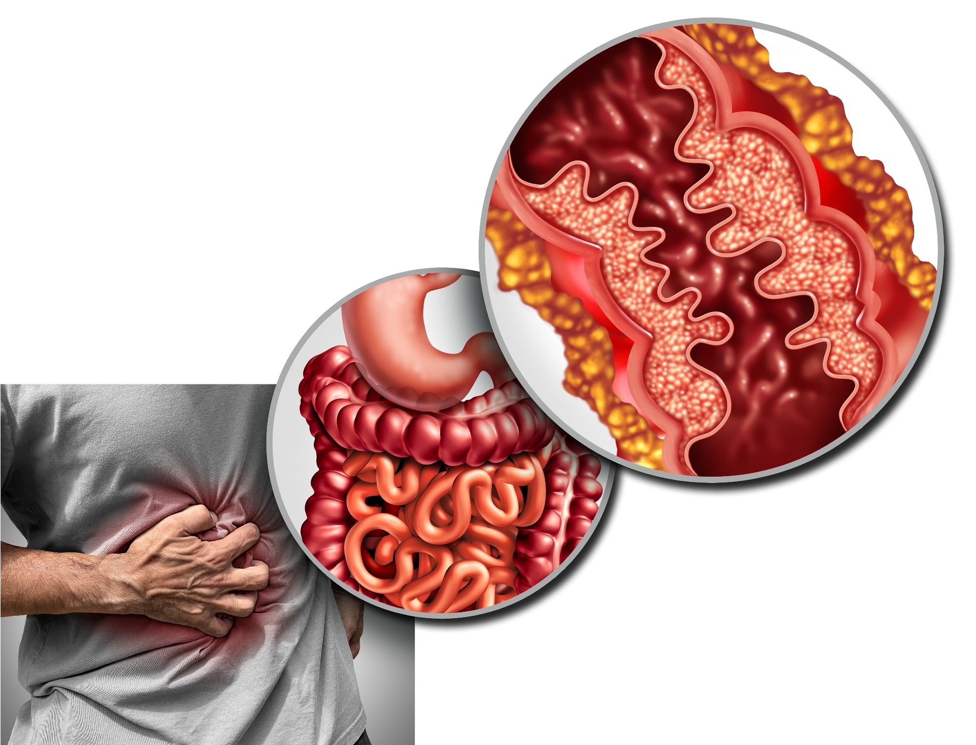 Study: Efficacy and safety of filgotinib as induction and maintenance therapy for Crohn