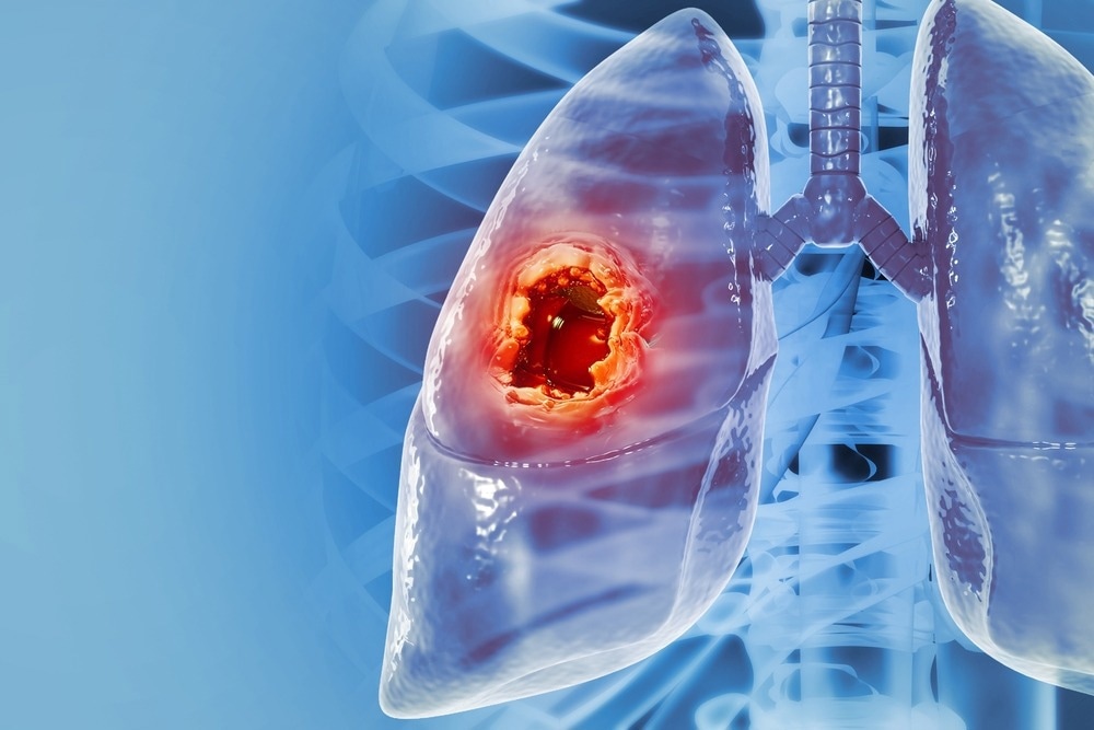 Medical illustration of a human lung highlighting a tumor in red, representing lung cancer, with a blue anatomical background.