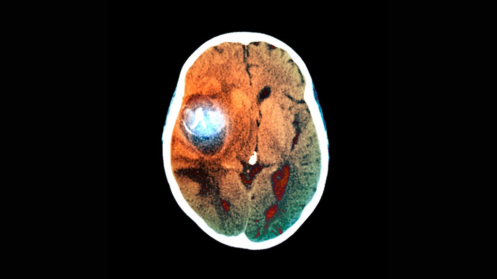 brain aneurysm image