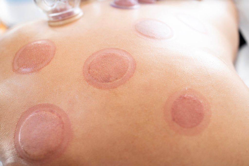 Wet cupping marks and cuts on patient after hijama treatment.