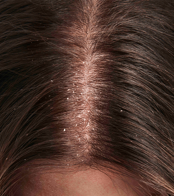 Scalp before using Zoryve