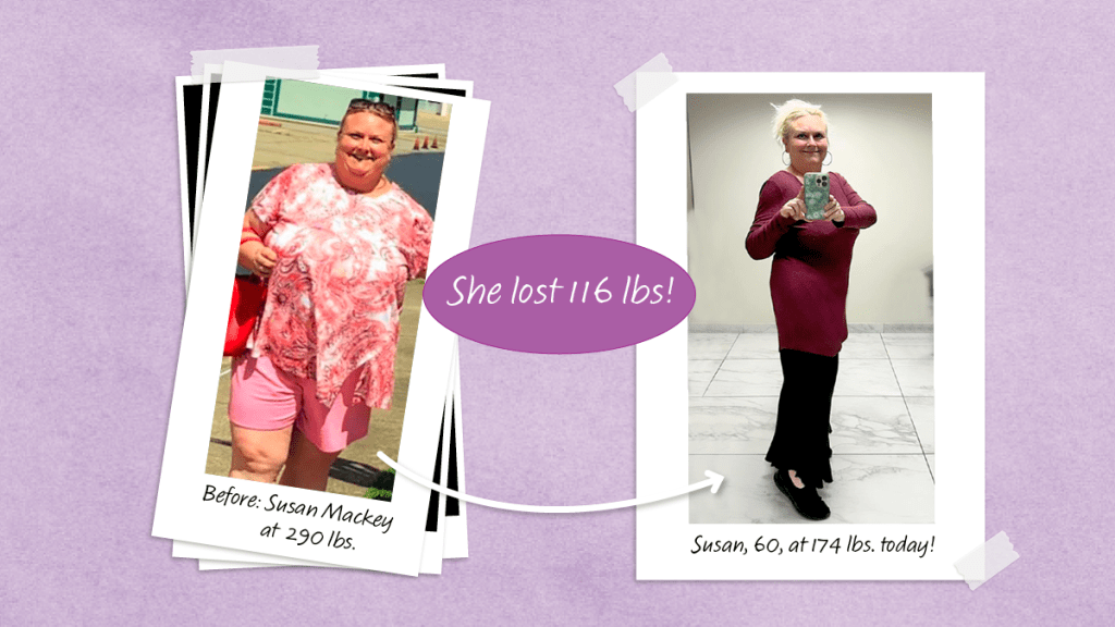 One woman, Susan Mackey, shares her before and after photos from her amazing 116-pound weight loss with bariatric surgery.