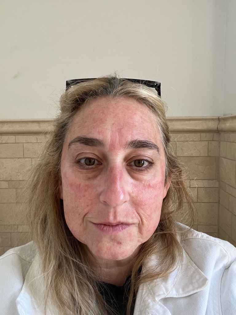 Immediately after treatment salmon sperm facial