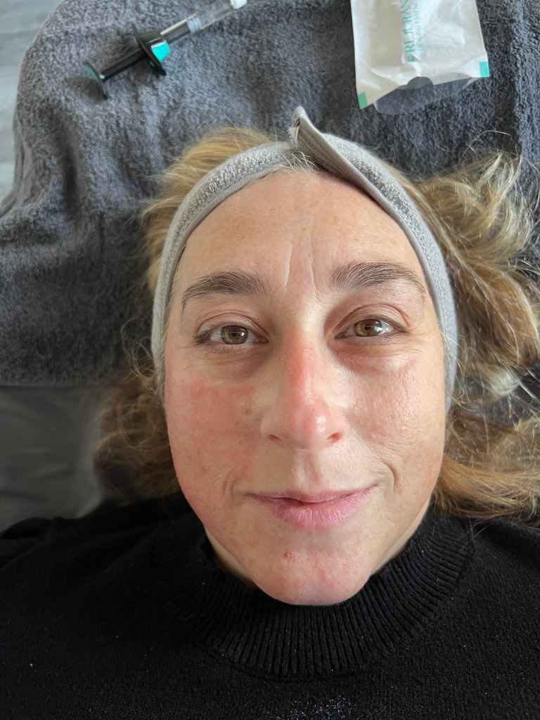 Mid treatment salmon sperm facial