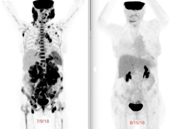 PET scan image showing a scan before and after CAR T-cell therapy. On the left, a scan with many tumors present, and on the right, no evidence of disease.